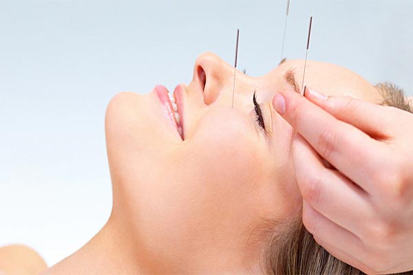 Acupuncture Acupuncture